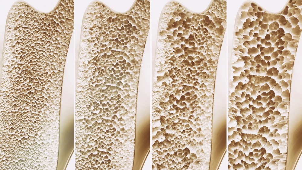 4 Stages of Osteoporosis