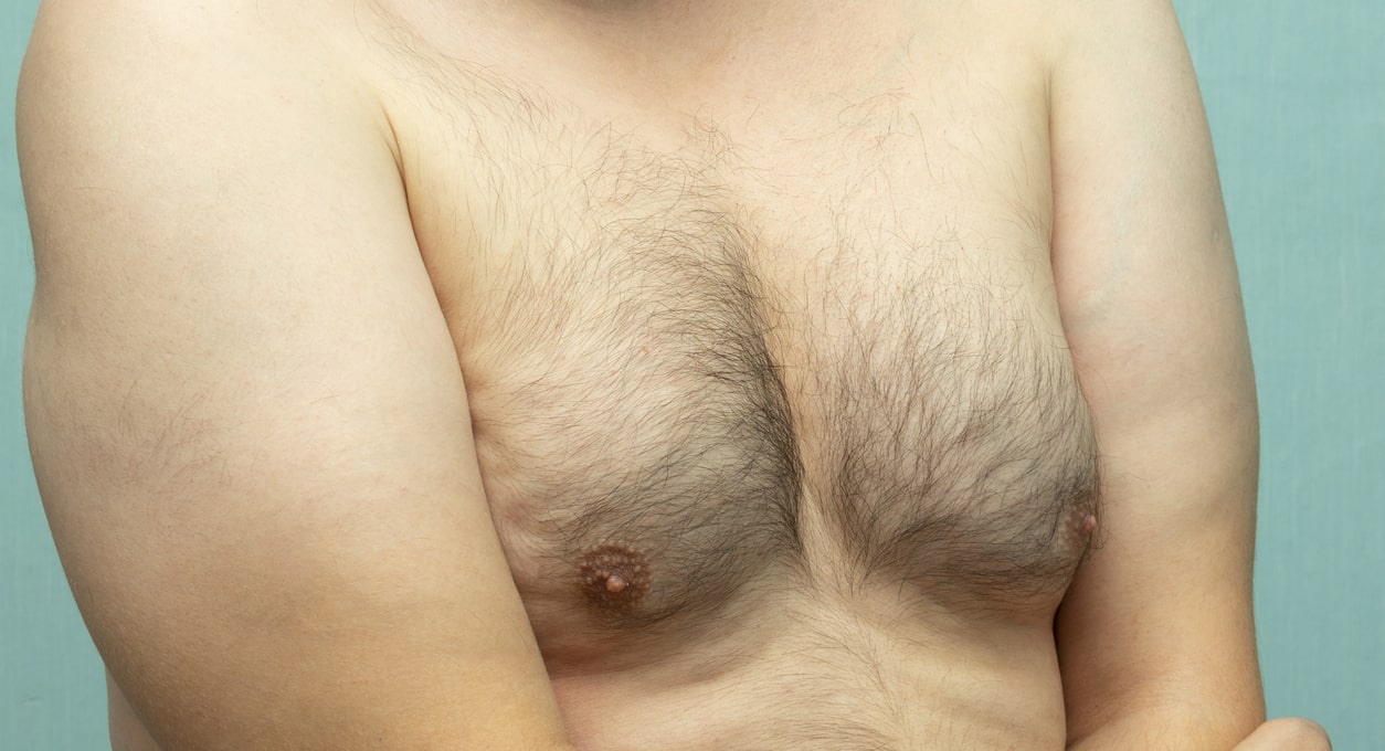 Gynecomastia - Can Low Testosterone Lead to Gynecomastia