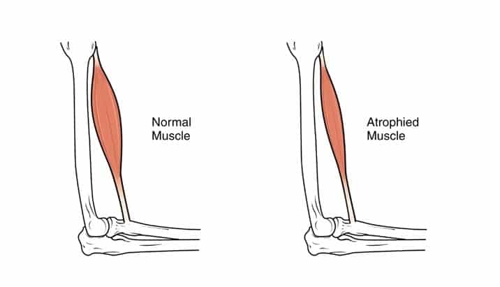 An illustrative representation of sarcopenia in older adults-min