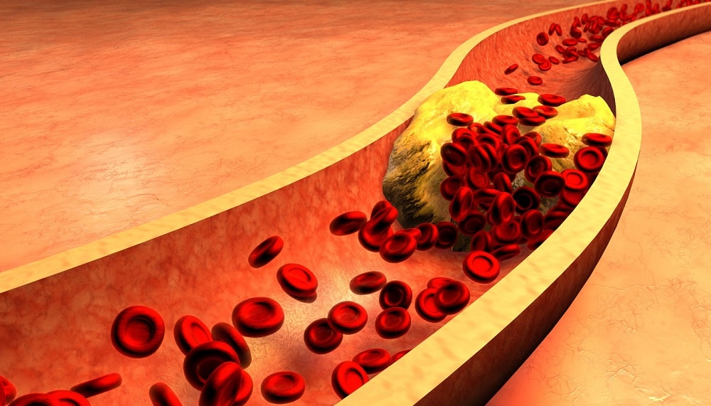 Clogged Artery with platelets and cholesterol plaque, concept for health risk for obesity or dieting and nutrition problems-min