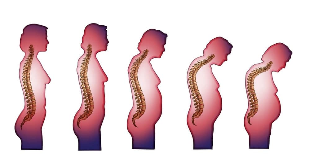 he most common osteoporosis symptoms include - stooped posture