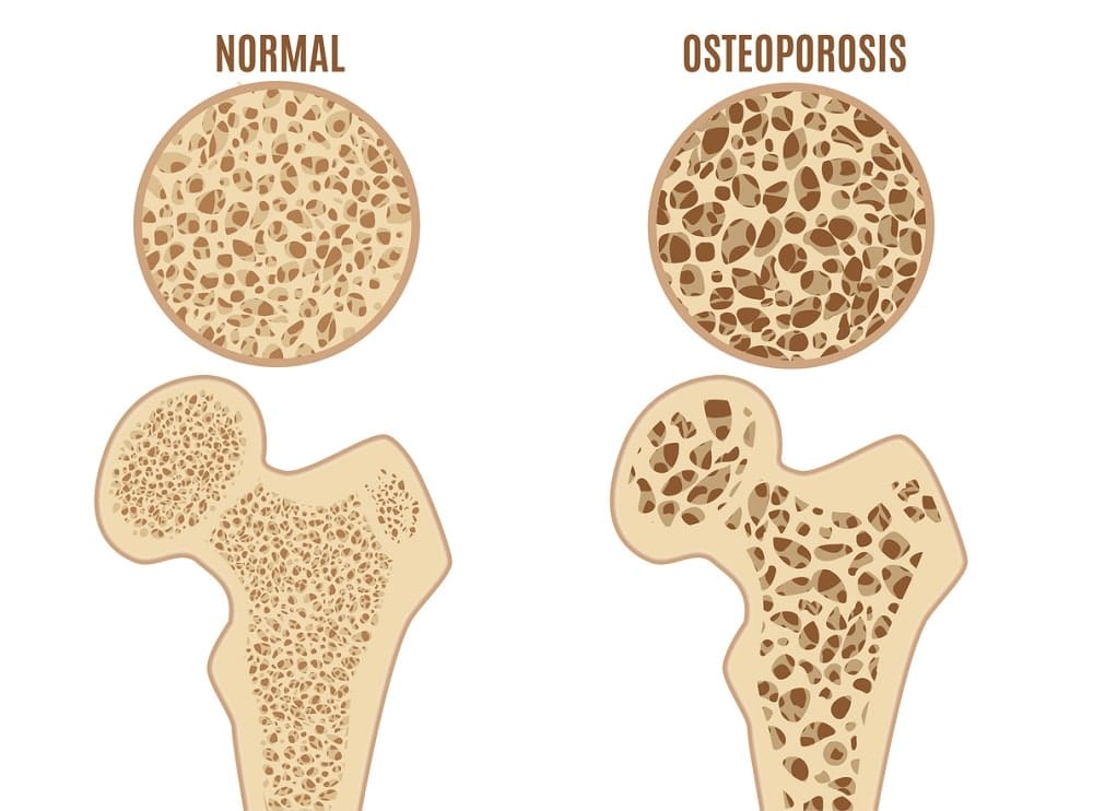 osteoporosis stages