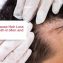Does HGH Cause Hair Loss or Hair Growth in Men and Women (FI)
