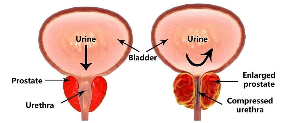 Normal and Enlarged Prostate Gland