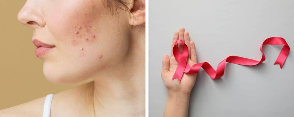 acne and cancer affect exocrine glands-1