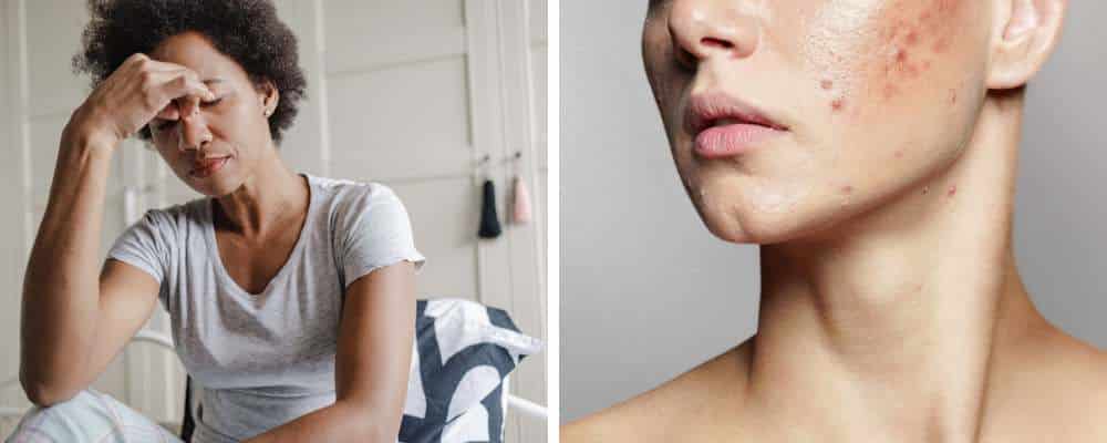 fatigue and acne are the main symptoms of hormone imbalance