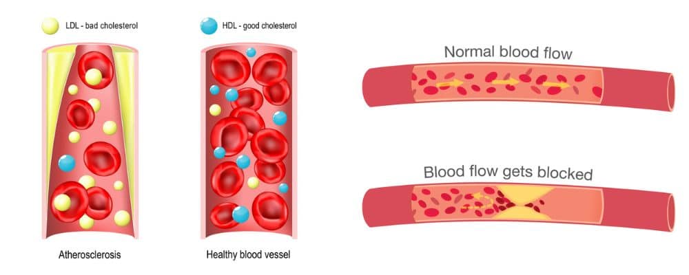 types of cholesterol